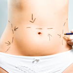 Mamoplastia redutora / Mastopexia